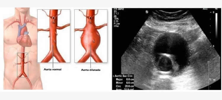 Aneurisma da Aorta Abdominal
