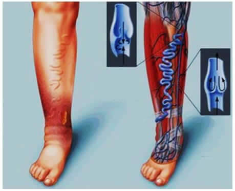 Complicações das varizes