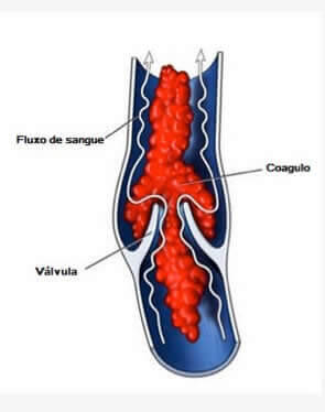 Complicações de varizes