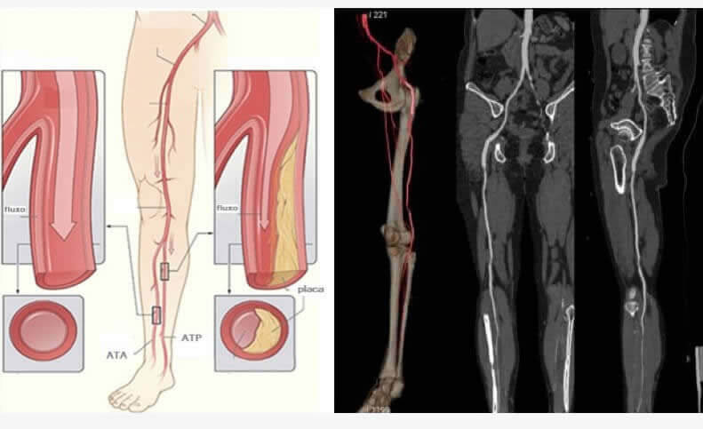 Doença Arterial Periférica