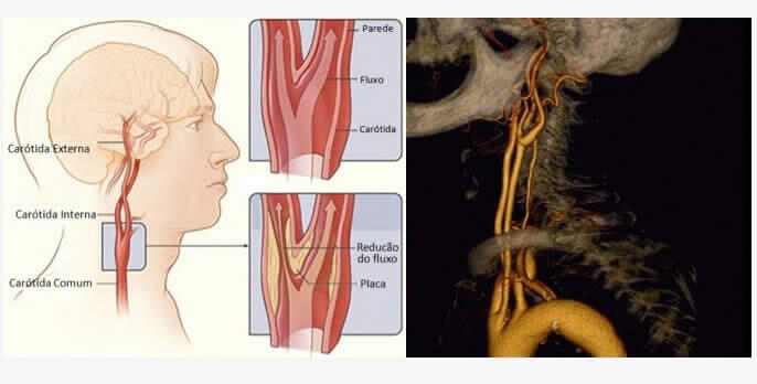 Doença das Artérias Carótidas