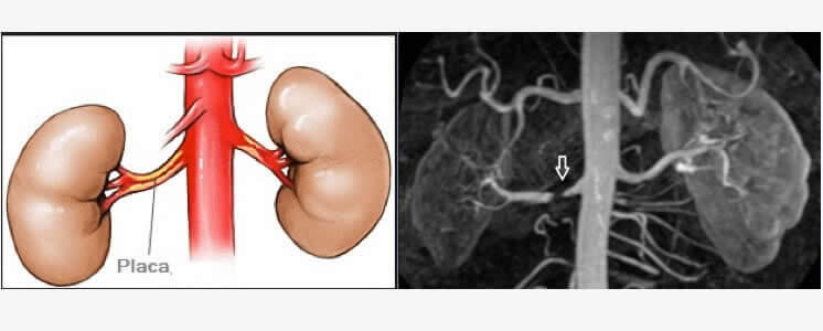 Doença Renal Crônica