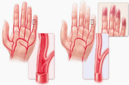 Síndrome de Reynaud
