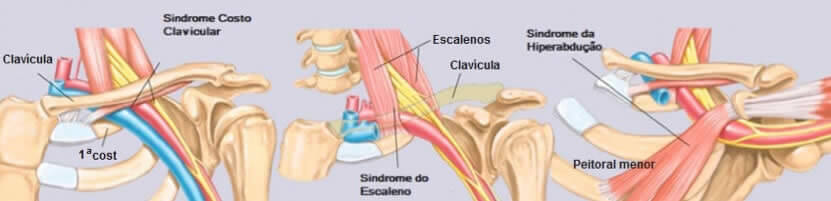 Síndrome do Desfiladeiro Torácico