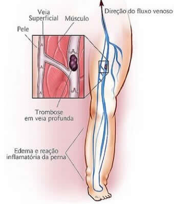 Trombose Venosa Profunda