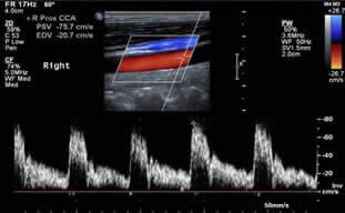 Ultrassonografia de Vasos Sanguíneos