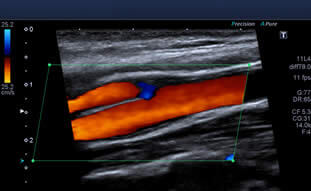 Ultrassonografia Vasos Sanguíneos