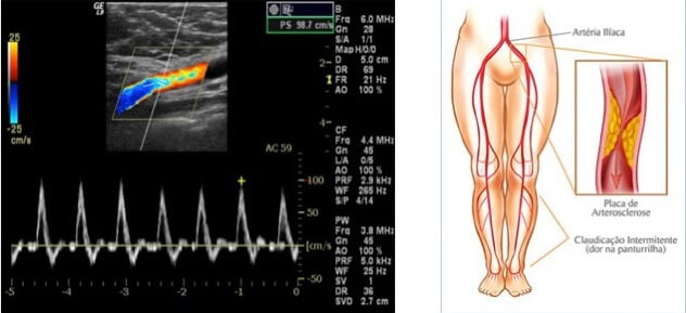 Doppler Colorido Arterial Periférico