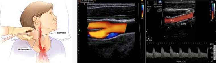 Doppler Colorido das Carótidas e Vertebrais
