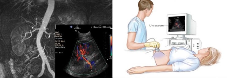Doppler Colorido Vascular Abdominal