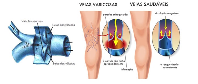 Doppler Colorido Venoso Periférico