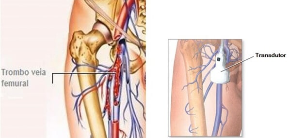 Investigação de Trombose Venosa Profunda