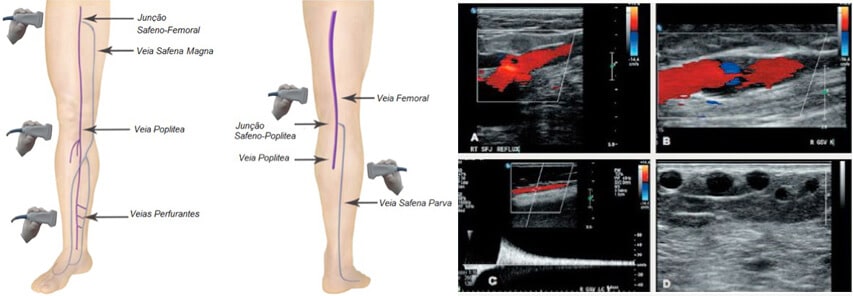 Mapeamento de Varizes