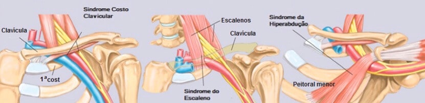 Síndrome Desfiladeiro Torácico